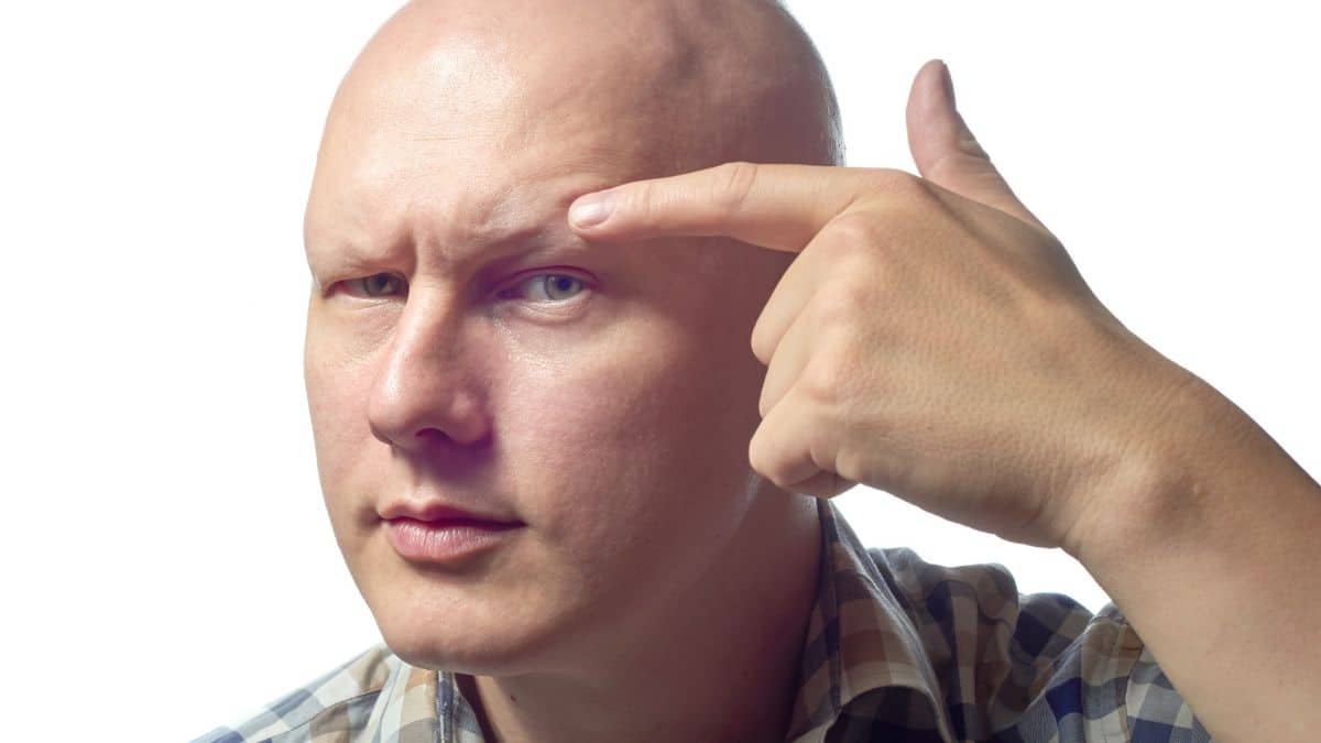 A man suffering from alopecia, an autoimmune disease