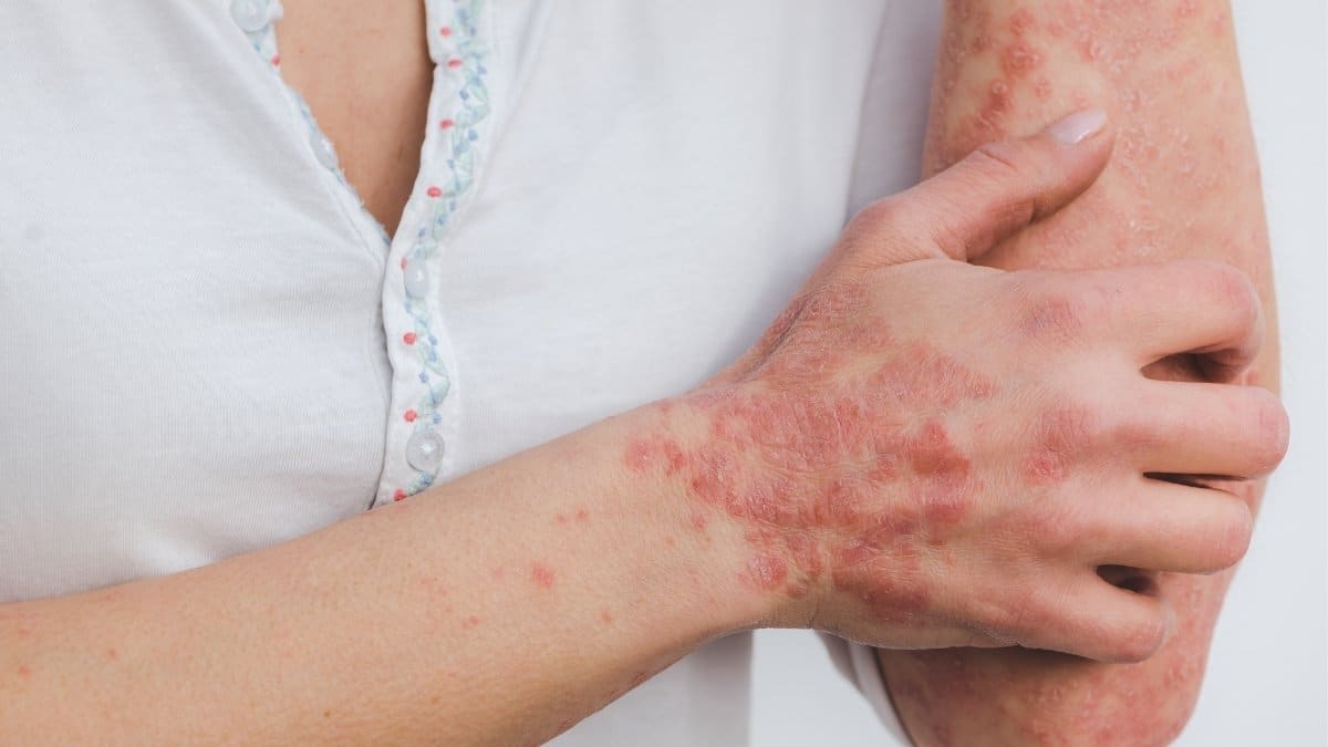 A woman suffering from psoriasis