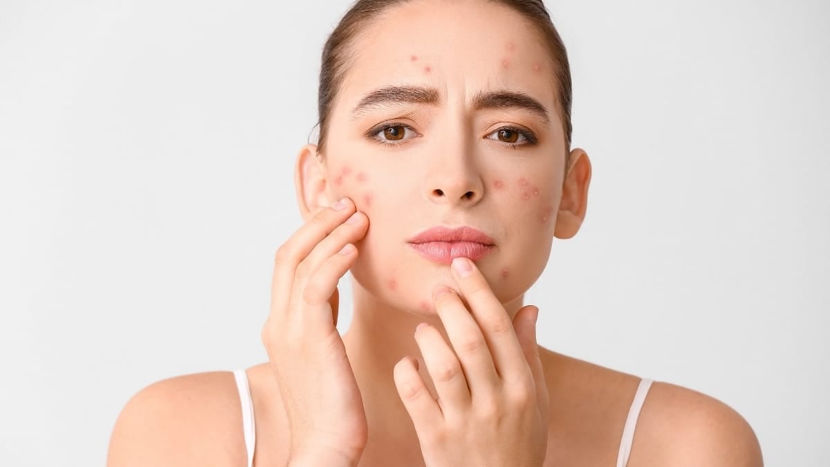 Face allergy- Allergic breakout on the face of a woman