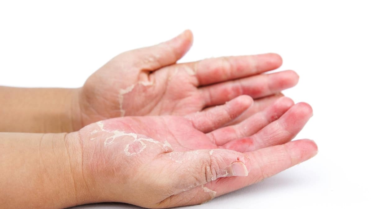 Fungal infection on hands