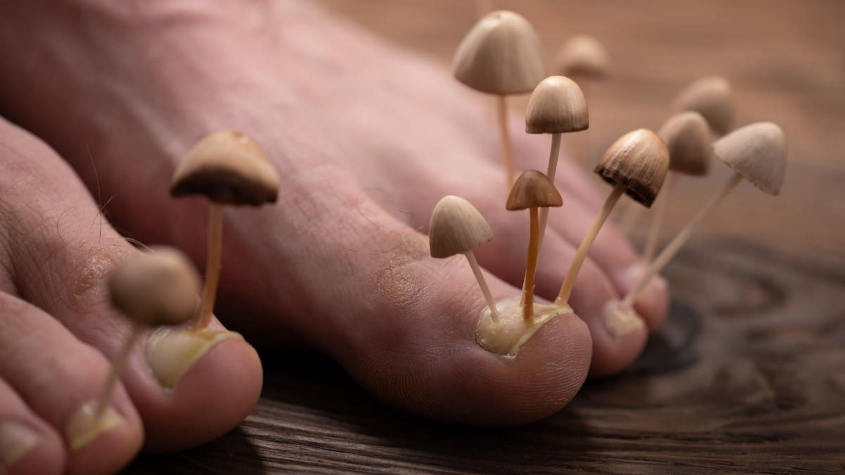 Athlete's Foot: Mushroom representing fungus on feet