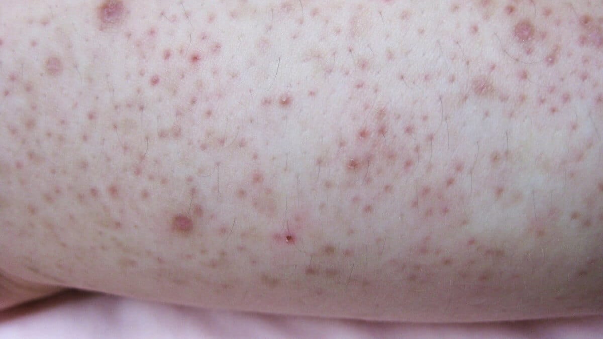 reddish lumps on human skin