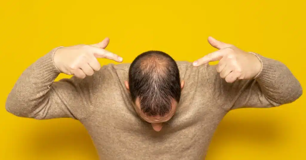 Male pattern baldness - side effects of steroid