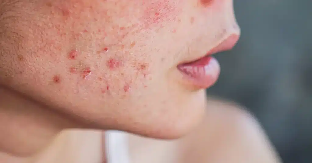 increased acne