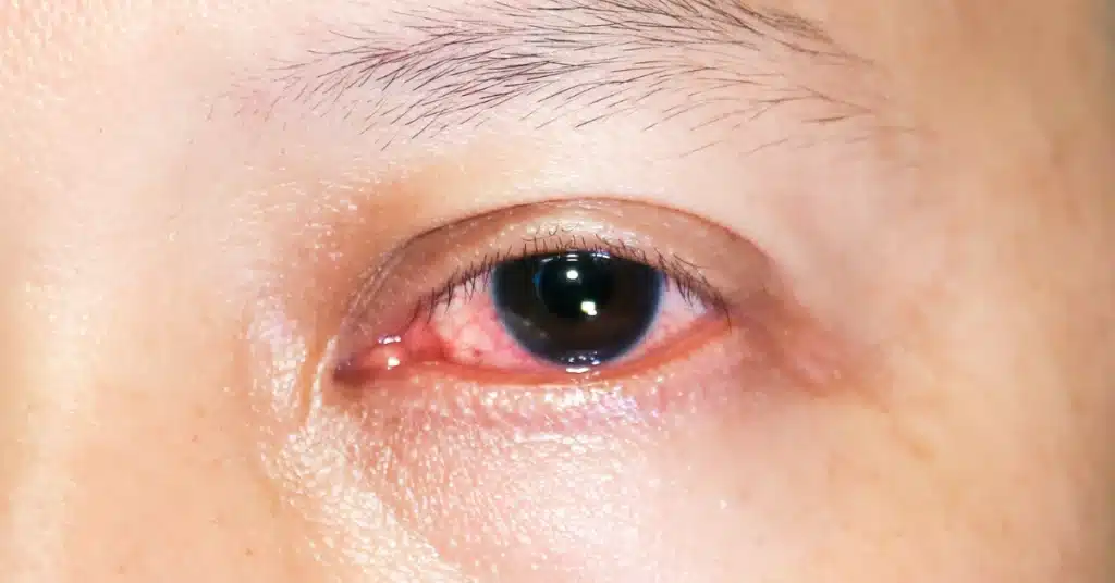 Allergic pink eye