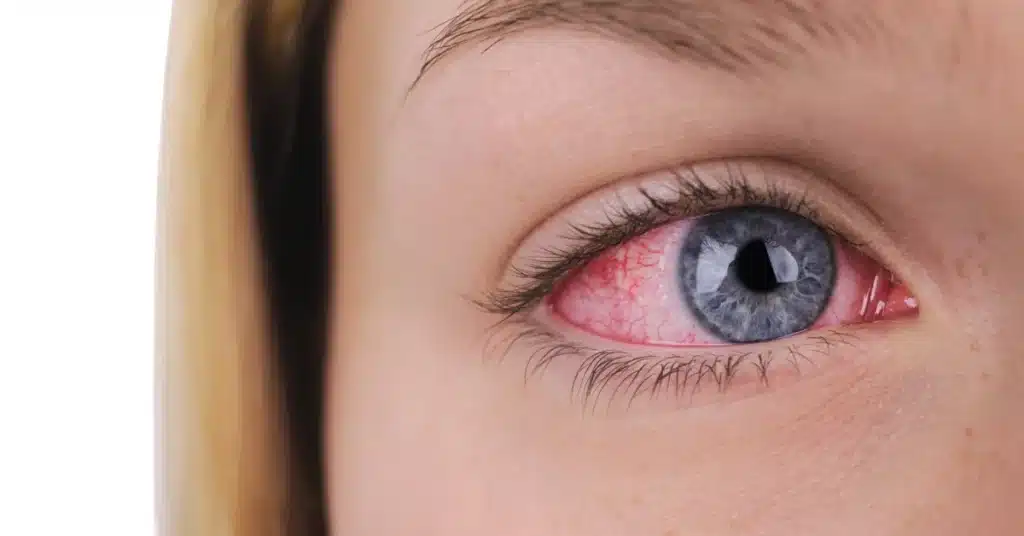 Closed Angle Glaucoma