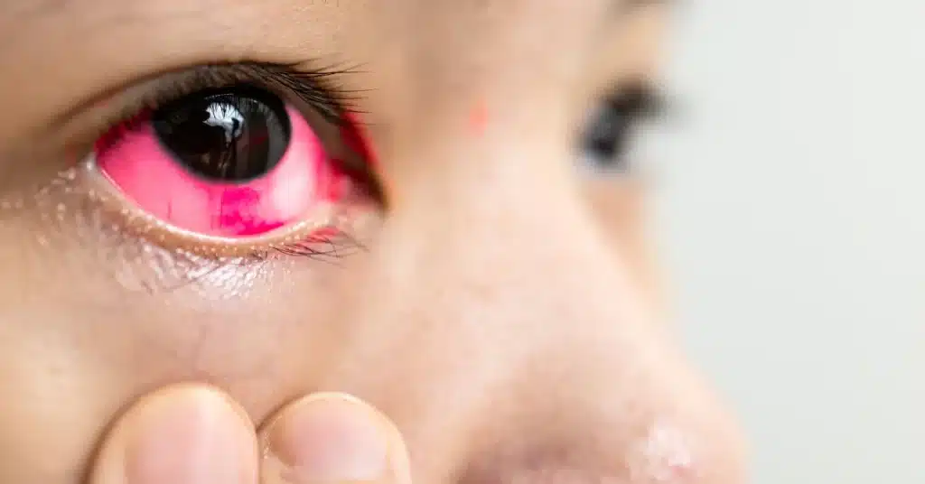 Closed Angle Glaucoma
