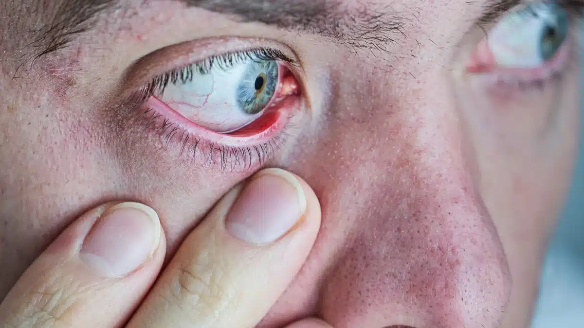 Dry Eye Symptoms