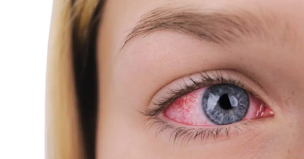 Allergic pink eye