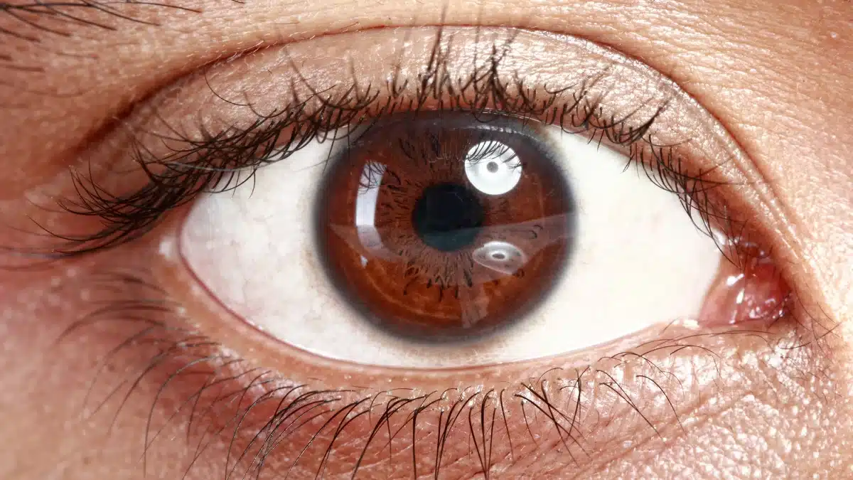 Normal Tension Glaucoma