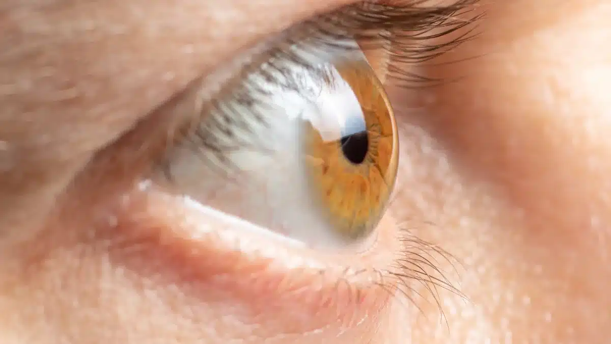 Ocular Hypertension vs Glaucoma