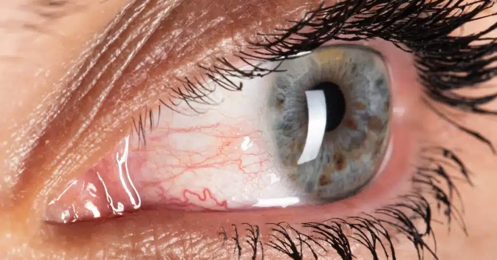 Glaucoma