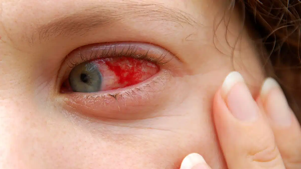 bacterial pink eye symptoms