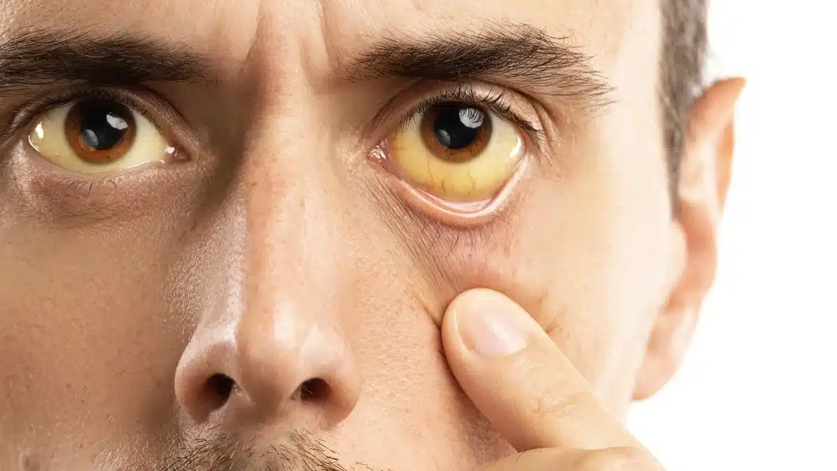 cataracts vs glaucoma