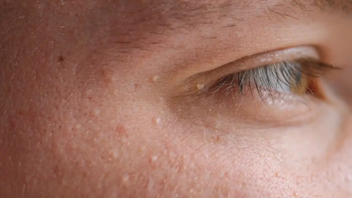Dry Skin Around Eyes Causes and its Prevention