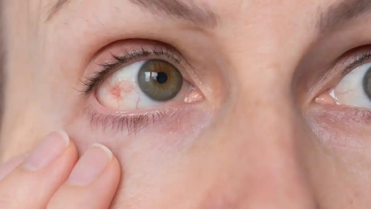 glaucoma medications to avoid