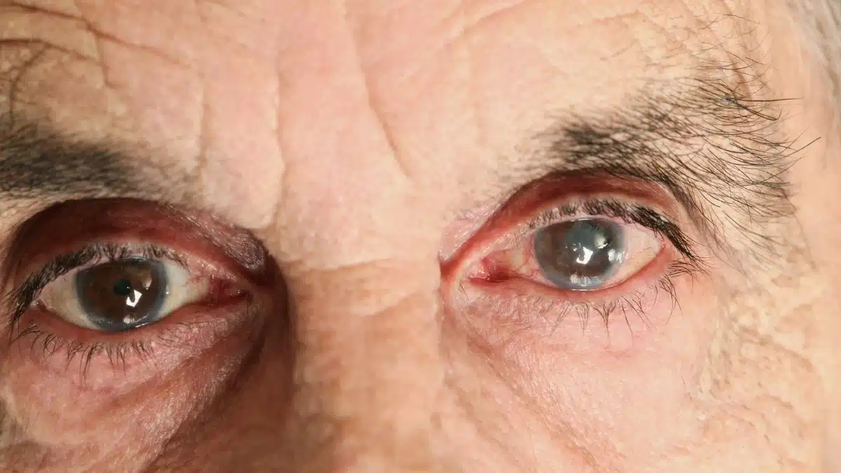 glaucoma red eye