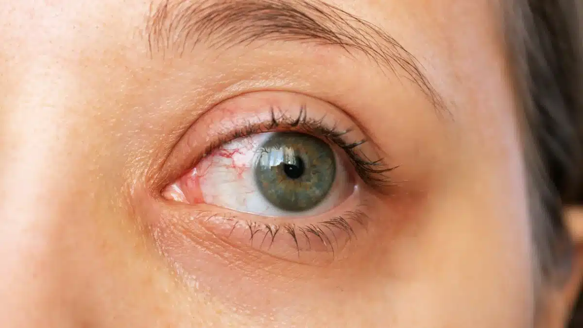 home remedies for dry eyes