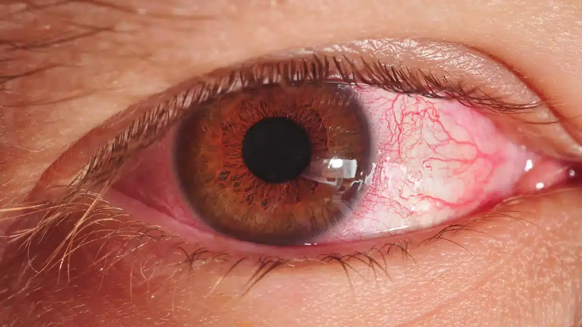 how does pink eye spread