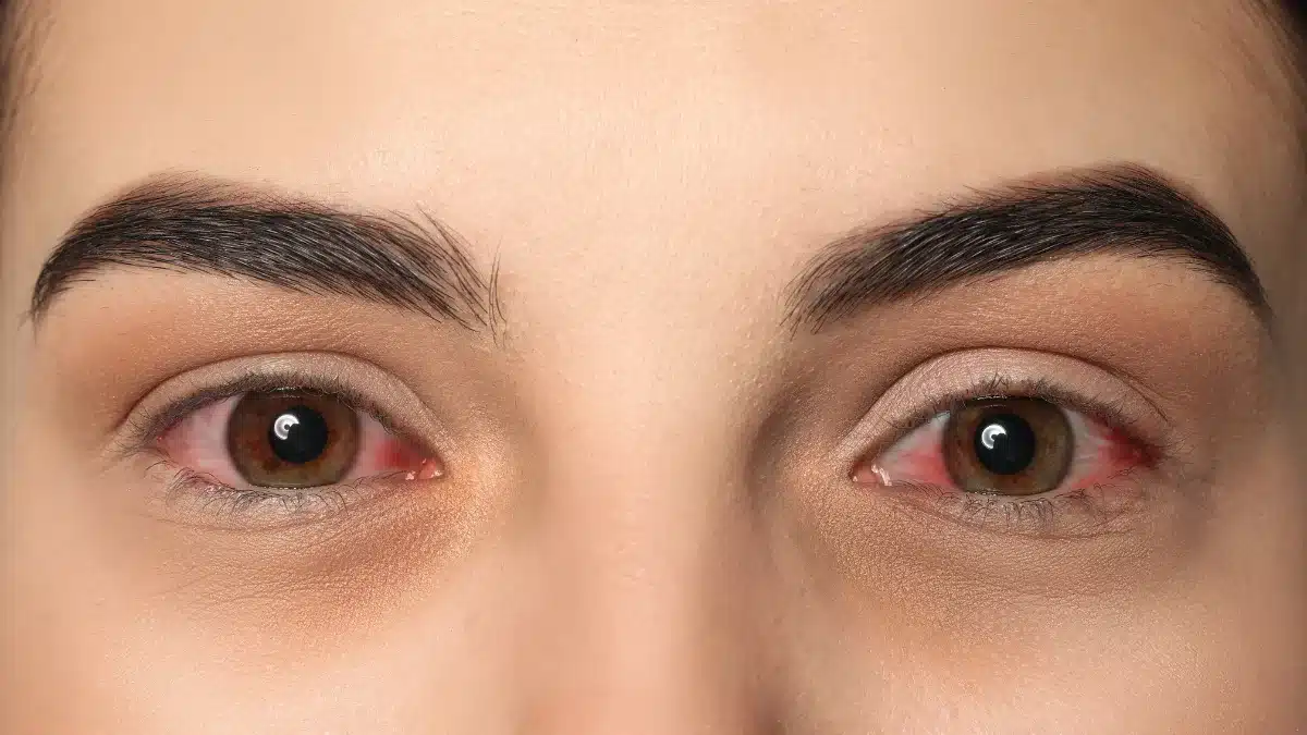 pink eye medicine