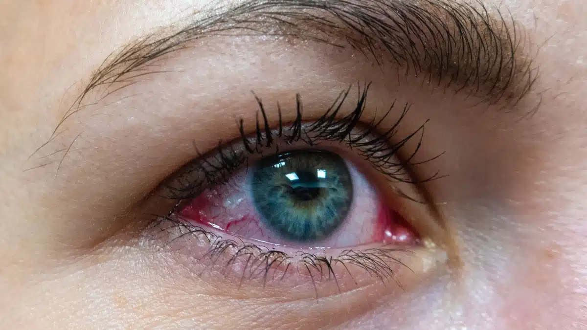 pink eye vs allergies