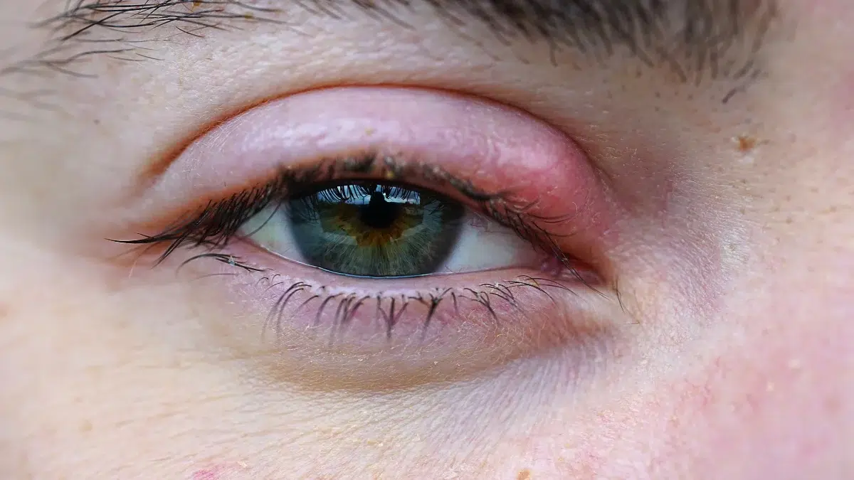 Pink Eye vs Stye Comparing the Causes, Symptoms, and Remedies