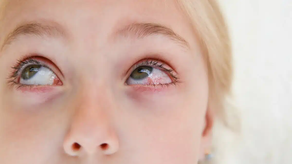 viral pink eye remedy