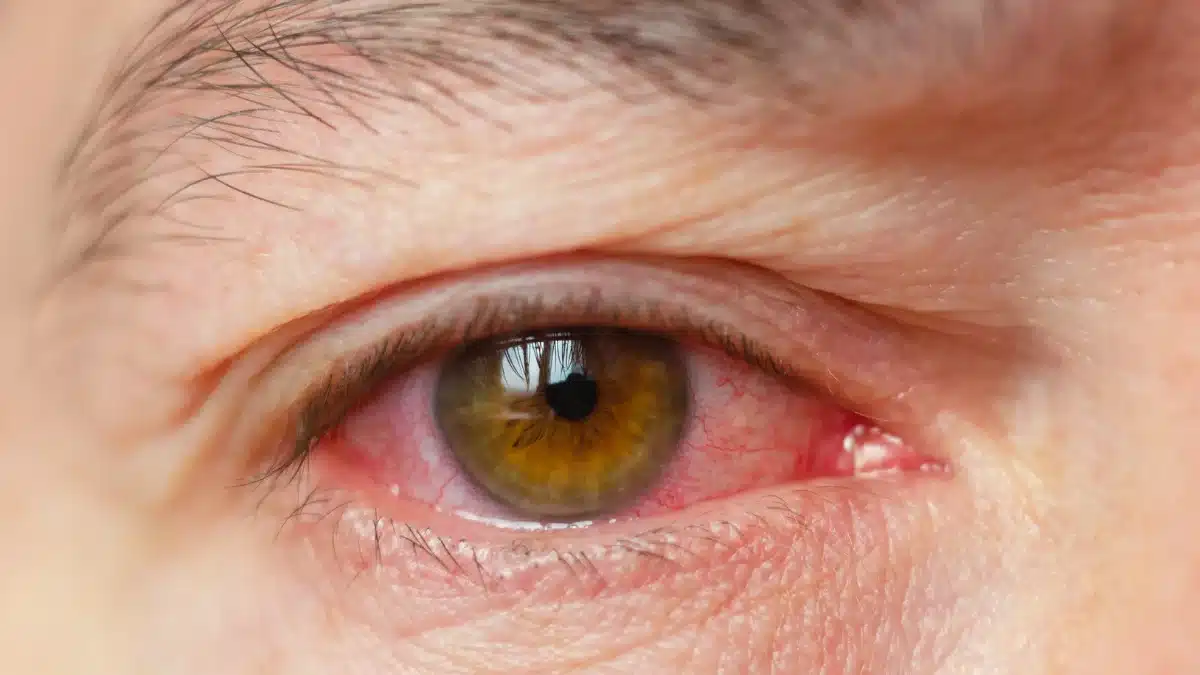 viral pink eye symptoms