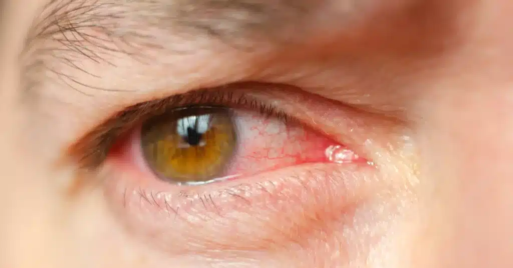 Chronic Anterior Uveitis (affecting front part of the eye)