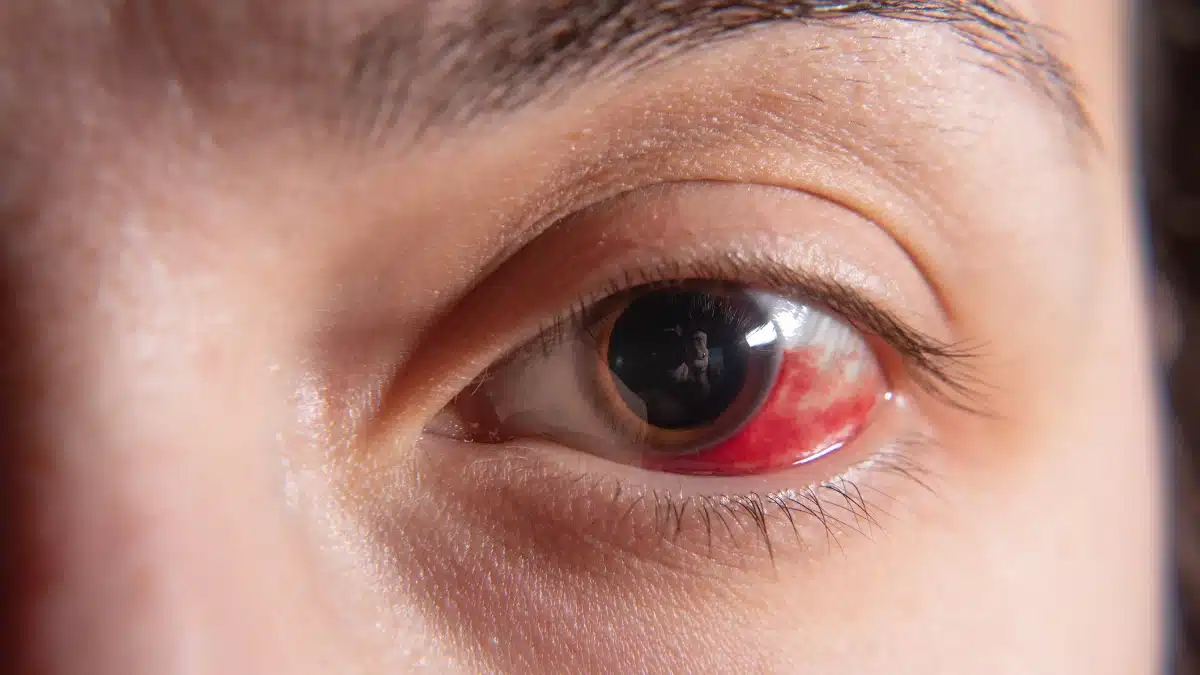 Exposure Keratitis