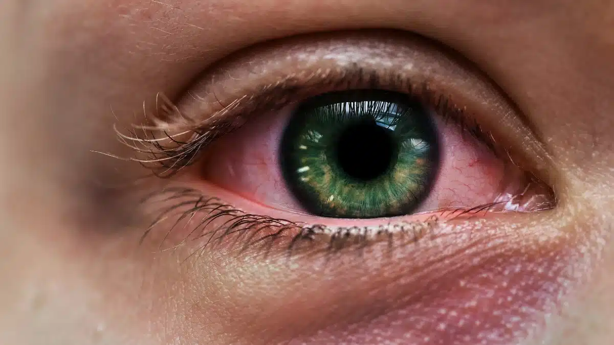 Eye Infection