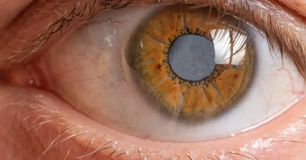 If acanthamoeba keratitis is left untreated can cause cataract