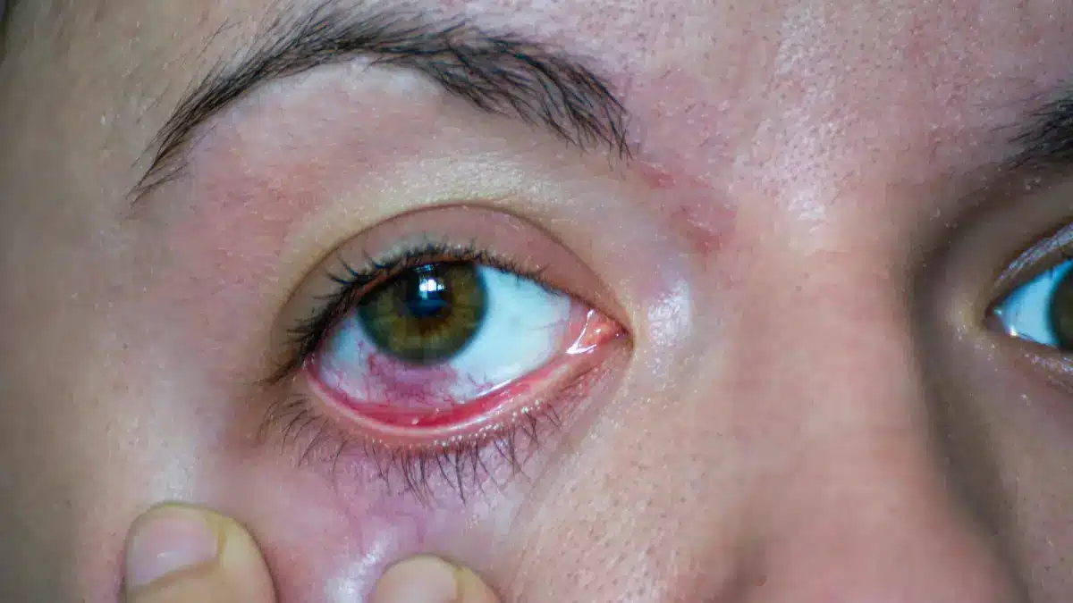 Pink Eye vs Red Eye