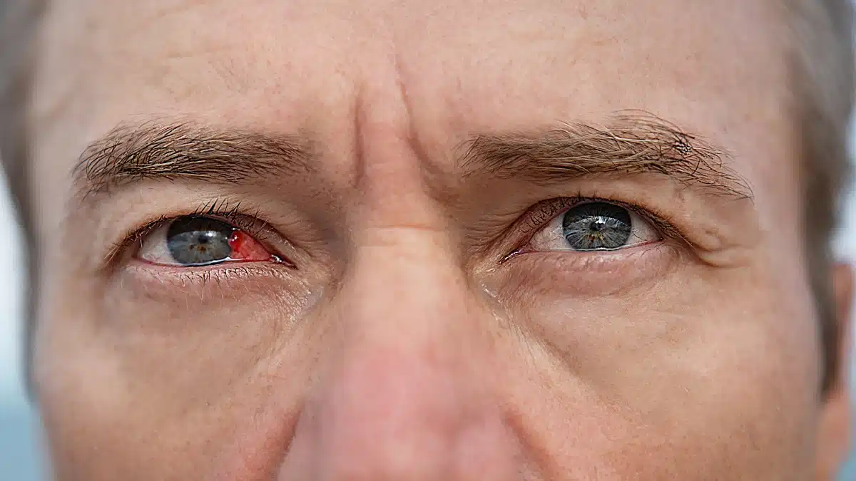 types of Eye Infection
