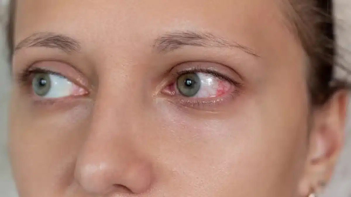 Uveitis
