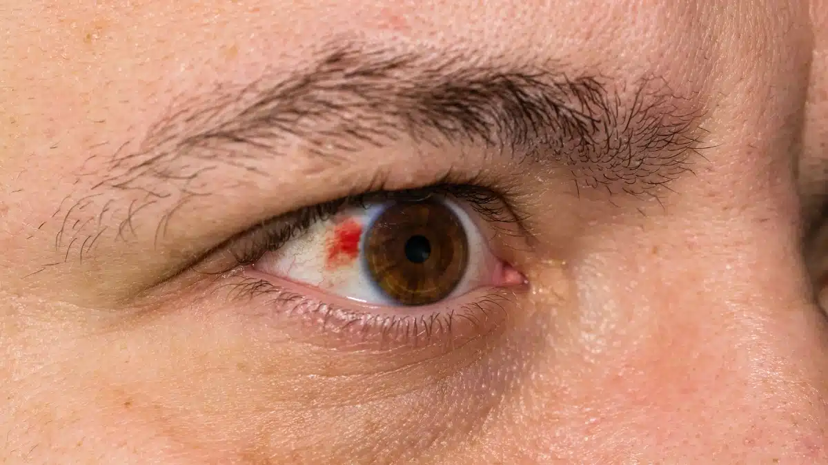 acanthamoeba keratitis