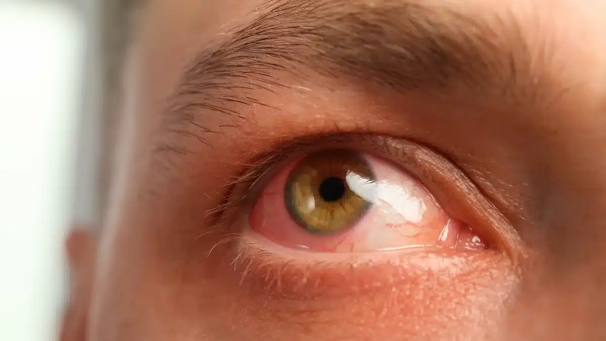 antibiotics for eye infection