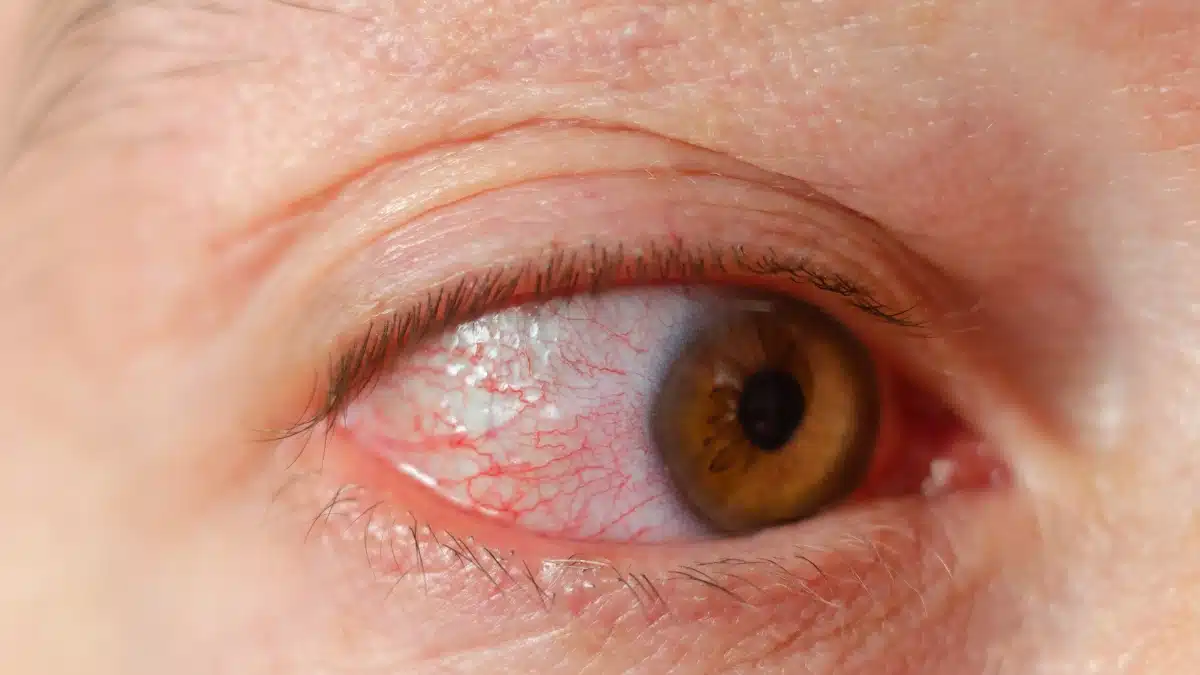bacterial keratitis