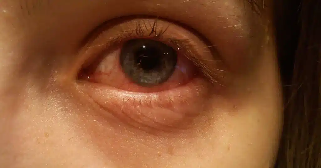 Bacterial pink eye