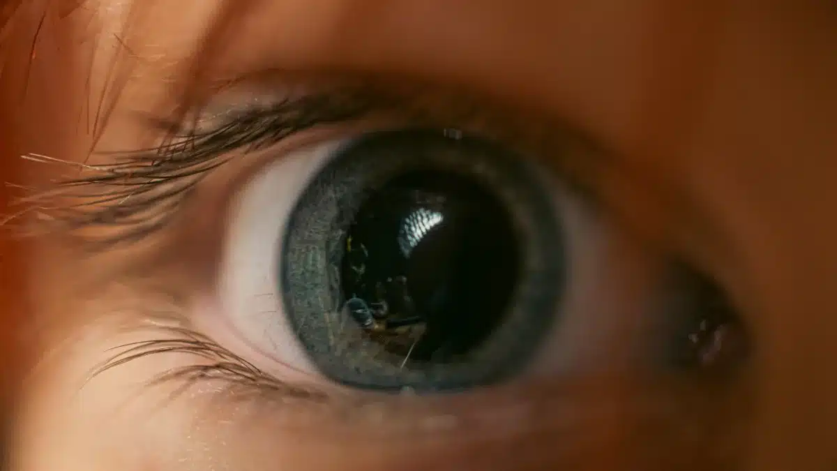 diffuse lamellar keratitis