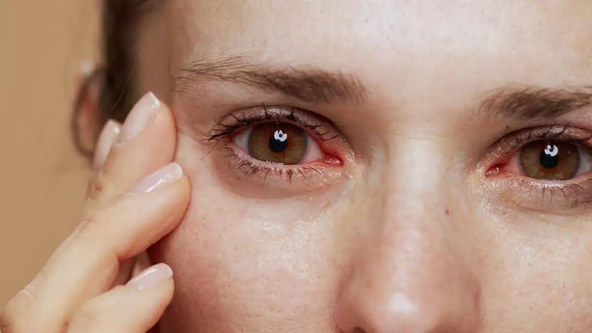 bacterial pink eye