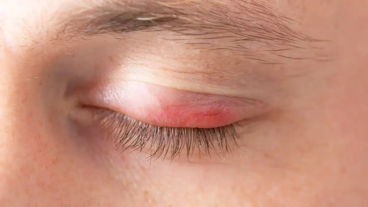 eye swollen and red