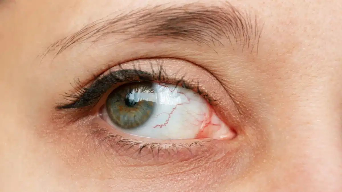 fungal keratitis