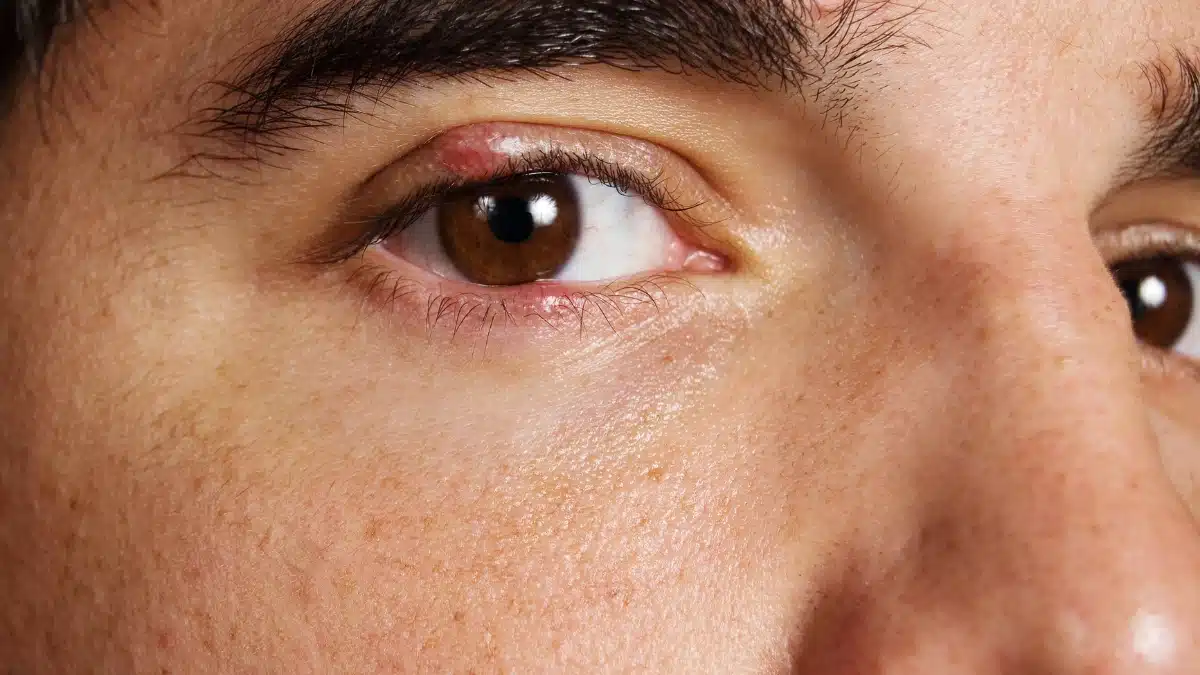 home remedies for eye infection