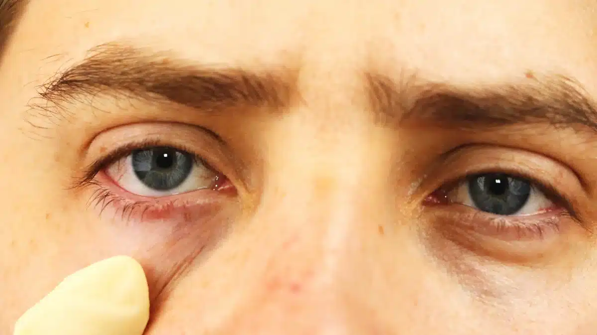 home remedies for red eyes