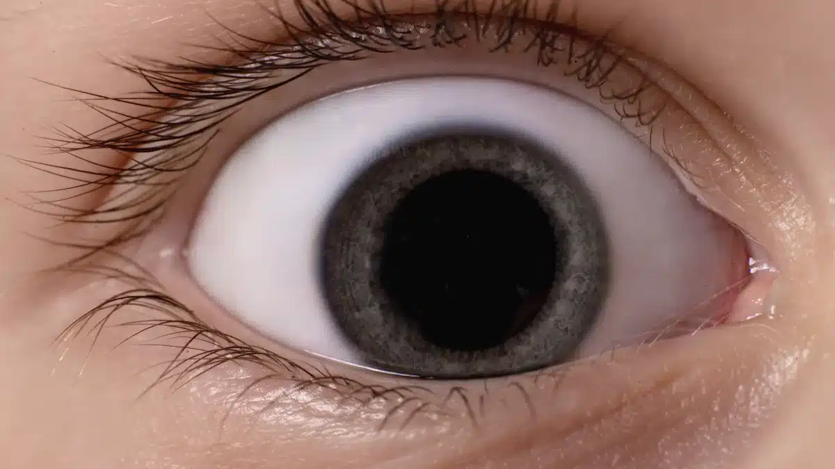 interstitial keratitis