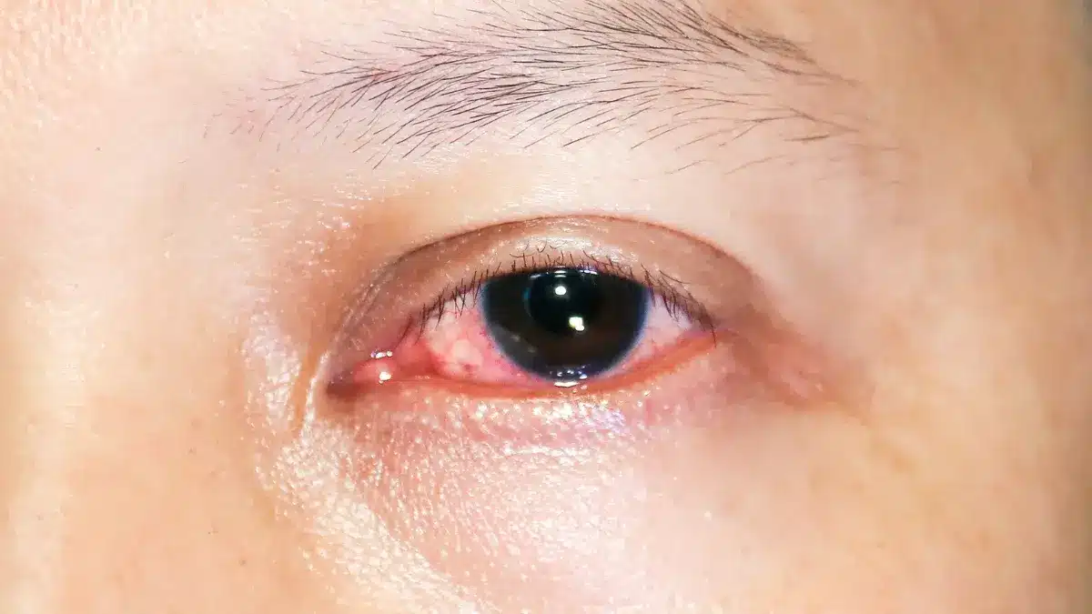 keratitis treatment