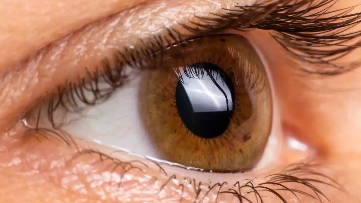 marginal keratitis