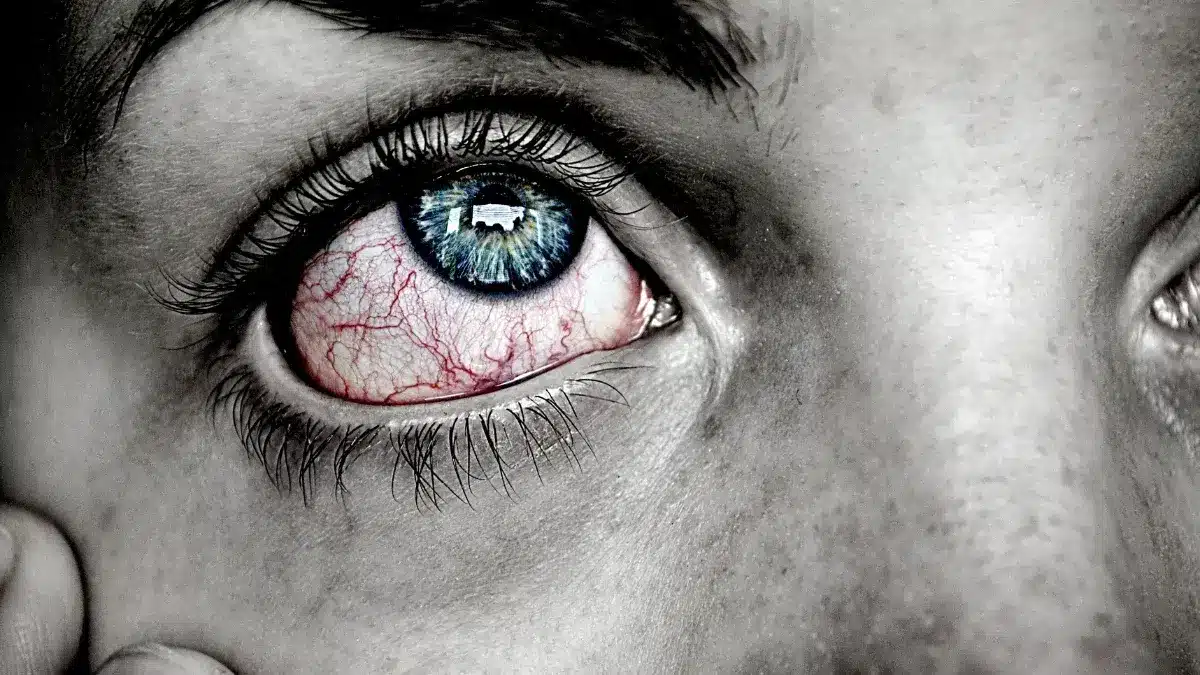 neurotrophic keratitis