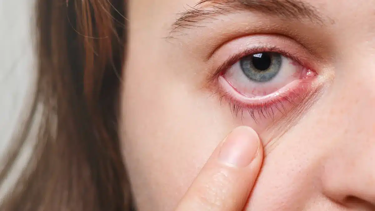 pink eye vs periorbital cellulitis